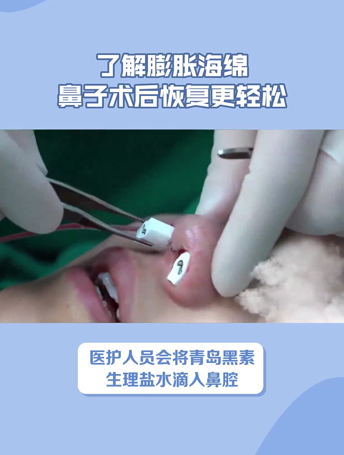 了解膨胀海绵鼻子术后恢复更轻松