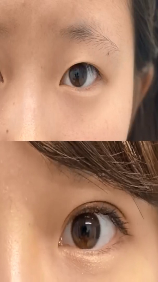 眼综合术后对比,眼睛亮晶晶更有神!