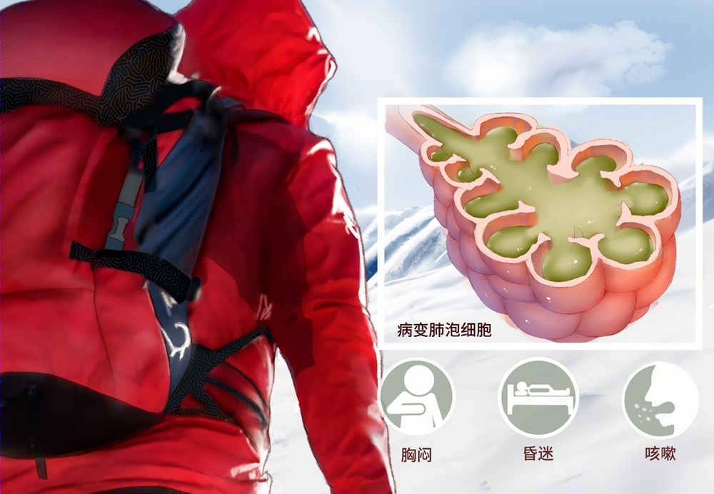 诺迪康胶囊:"红景天"能预防高原反应吗?