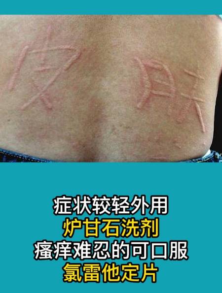 治疗人工性荨麻疹,其实也没那么难,可能是你的方法用错了!-度小视