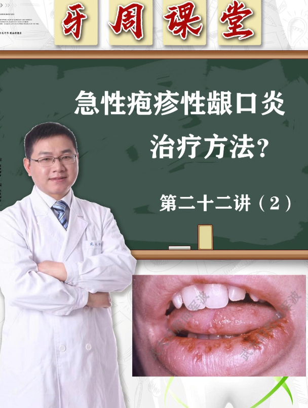 急性疱疹性龈口炎的治疗方法