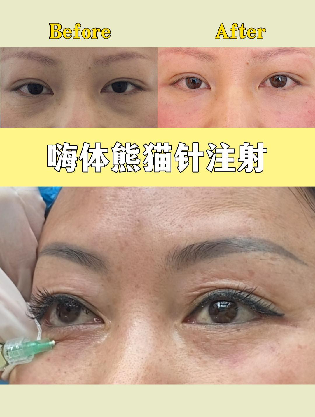 嗨体熊猫针注射前后对比