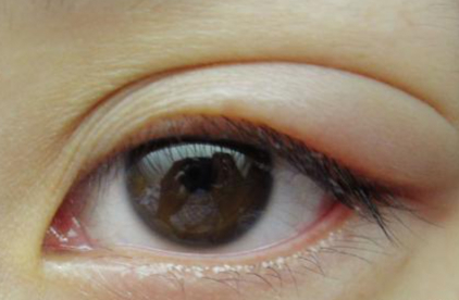 早上起来眼睛肿了怎么办?医生推荐3个方法快速消除肿眼泡