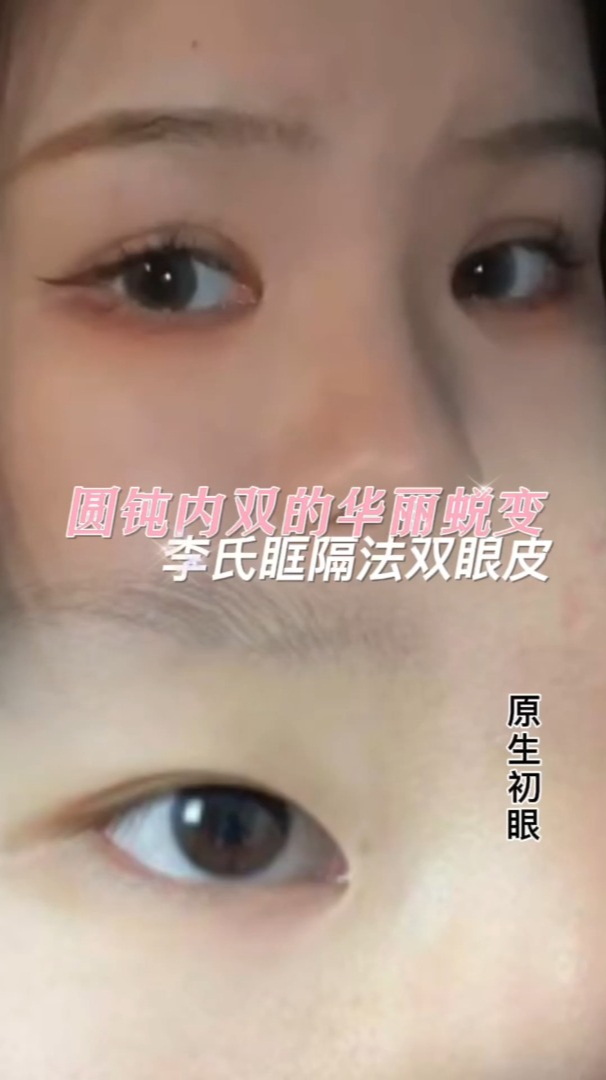 改善双眼内眦赘皮小透明变大女主