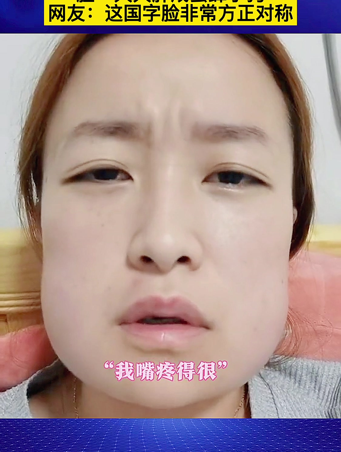 女子一口气拔四颗智齿后脸变肿网友这国字脸非常方正对称