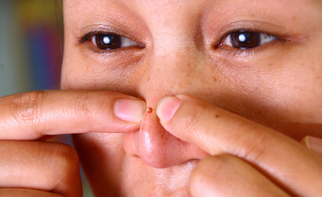 鼻子上挤出来的白色的东西,到底是什么?能抠出来不