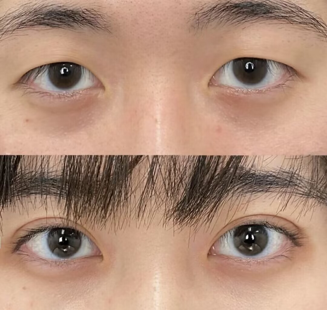 选择大于努力?25岁小姐姐双眼皮术前术后效果图