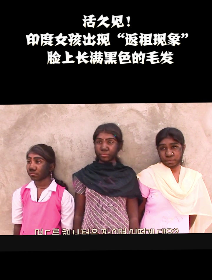活久见!印度女孩出现"返祖现象",脸上长满黑色的毛发(2)