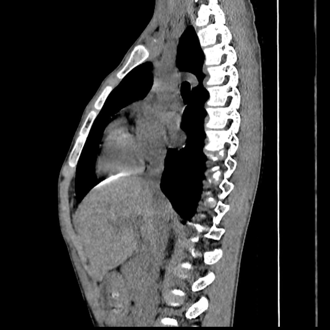 漏斗胸和鸡胸,扁平胸如何区别?