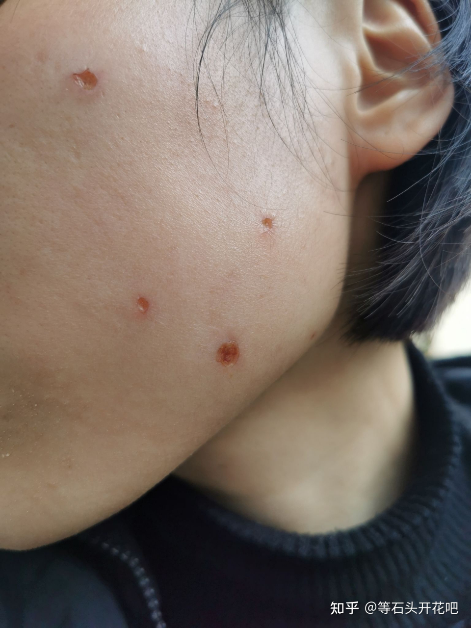 点痣方法选不对,分分钟毁容  1,药水点痣,这个方法最不推荐,它是用
