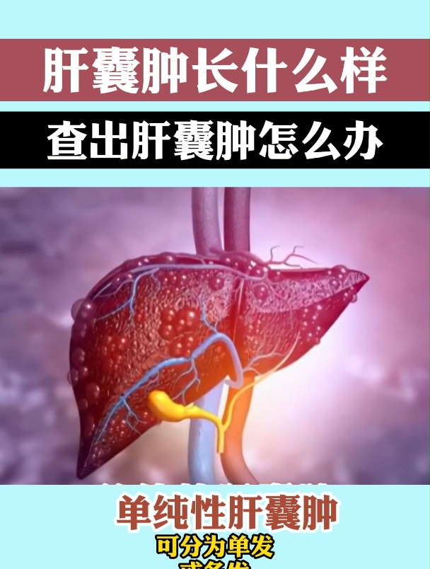 肝囊肿 健康科普
