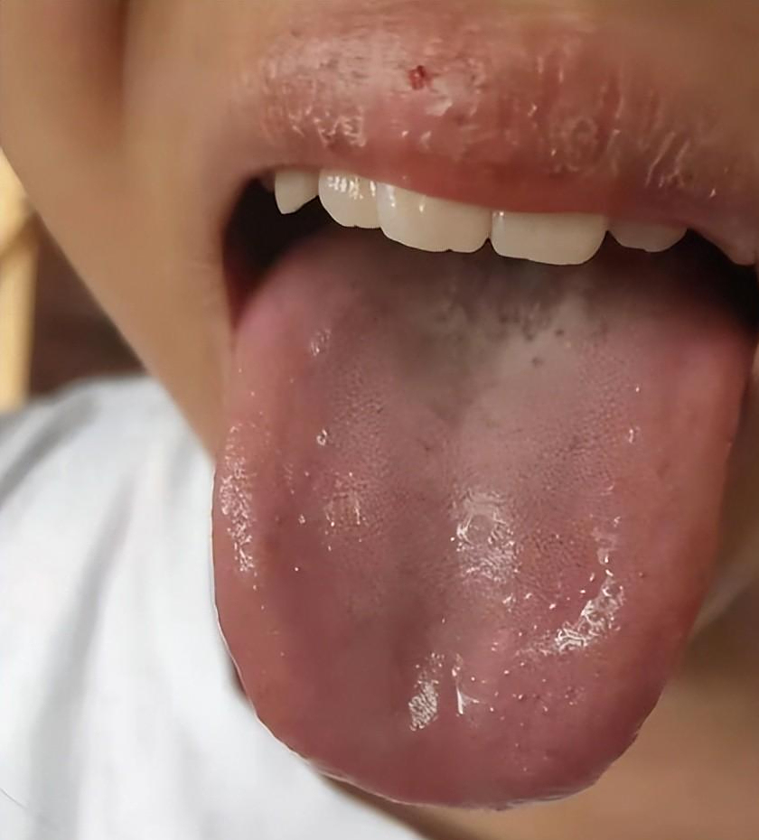 舌诊分析舌尖凹进去都有什么问题