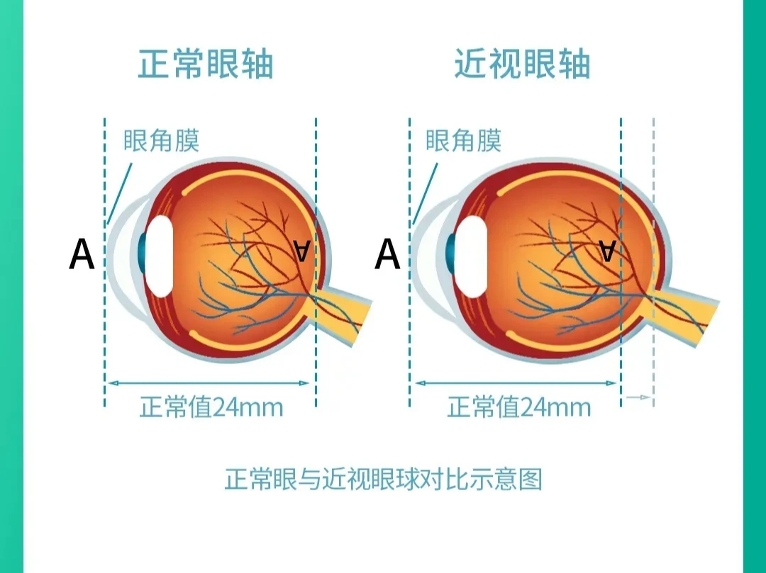 眼睛近视分析图图片