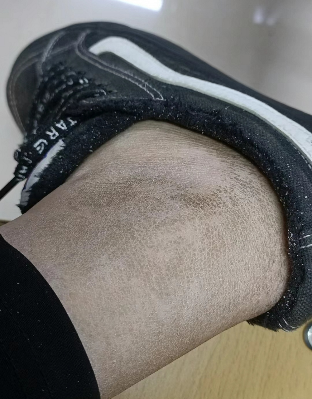 网友:一觉睡醒腿上的皮肤竟然变成黑色的了,要看看我