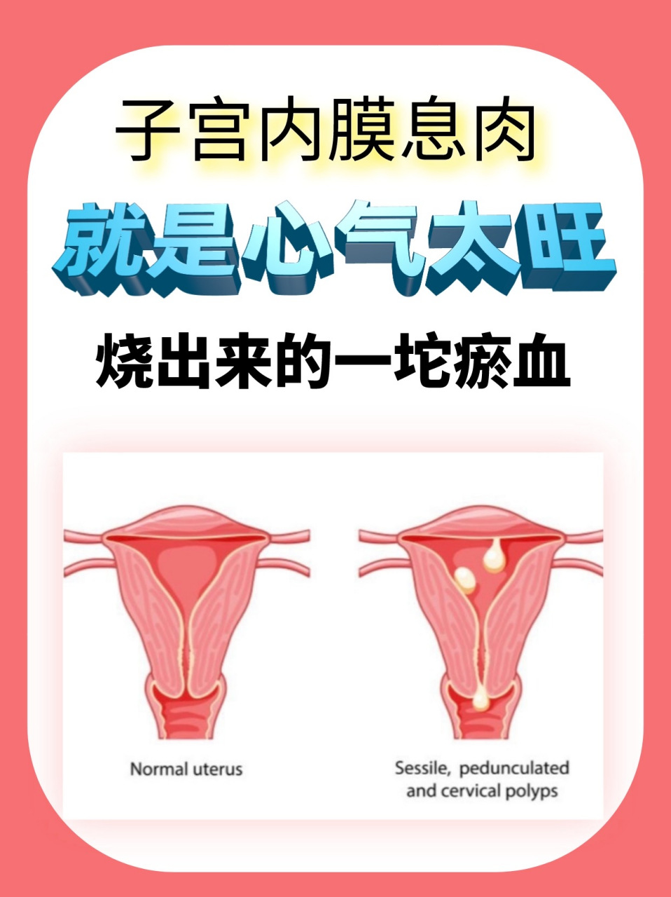 子宫内膜息肉,就是心气太旺,烧出来的一坨淤血!