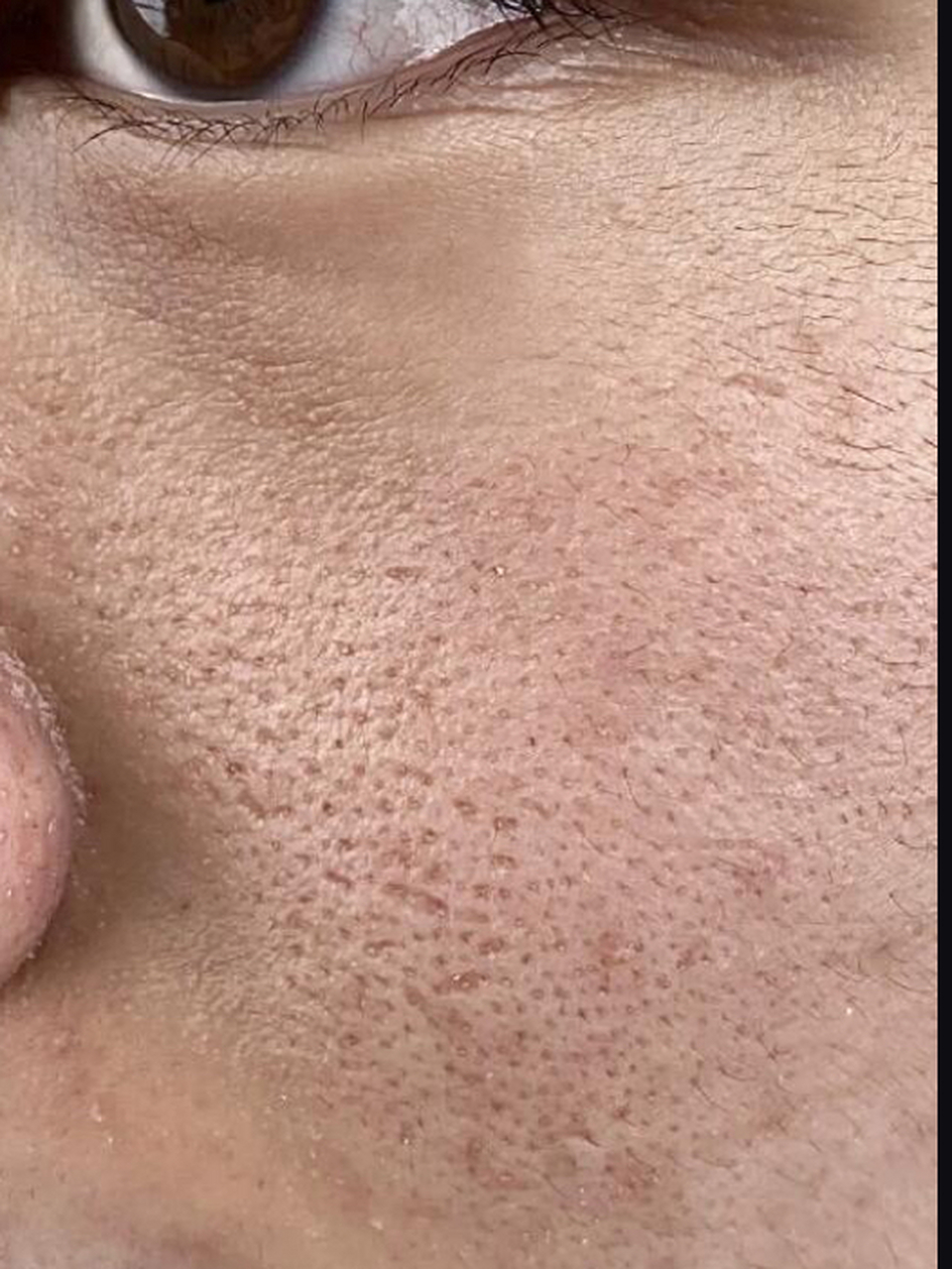 毛孔粗 #e光嫩肤#   当皮肤老旧角质积聚越多,会使肌肤变厚,变粗糙