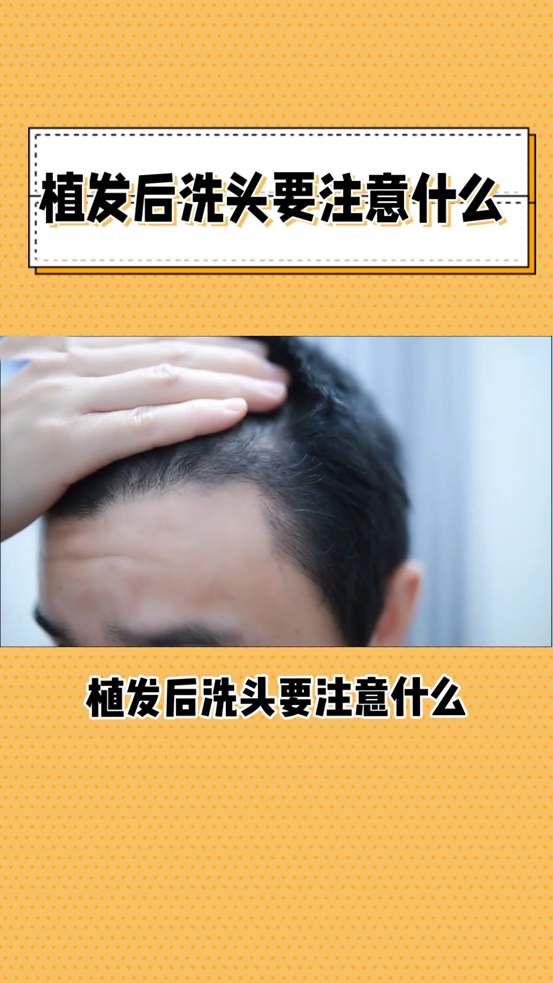 植发士冼发膏(植发洗发水品牌排行榜)