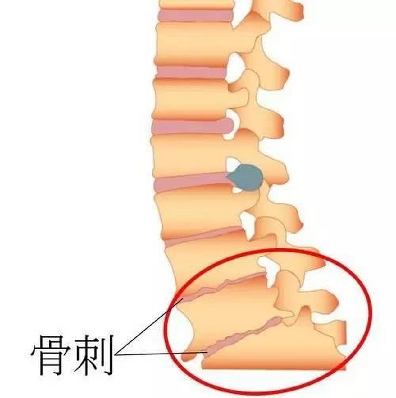 骨质增生的形成,治疗与预防  骨质增生是一种自然生理现象,随着年龄