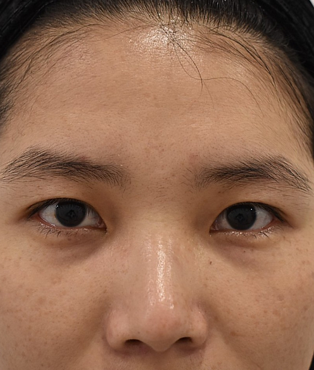 泪堂凹陷 怎么改善呢?