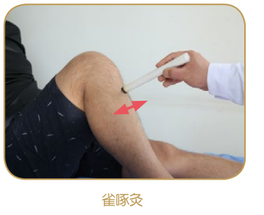 艾条灸:雀啄灸法