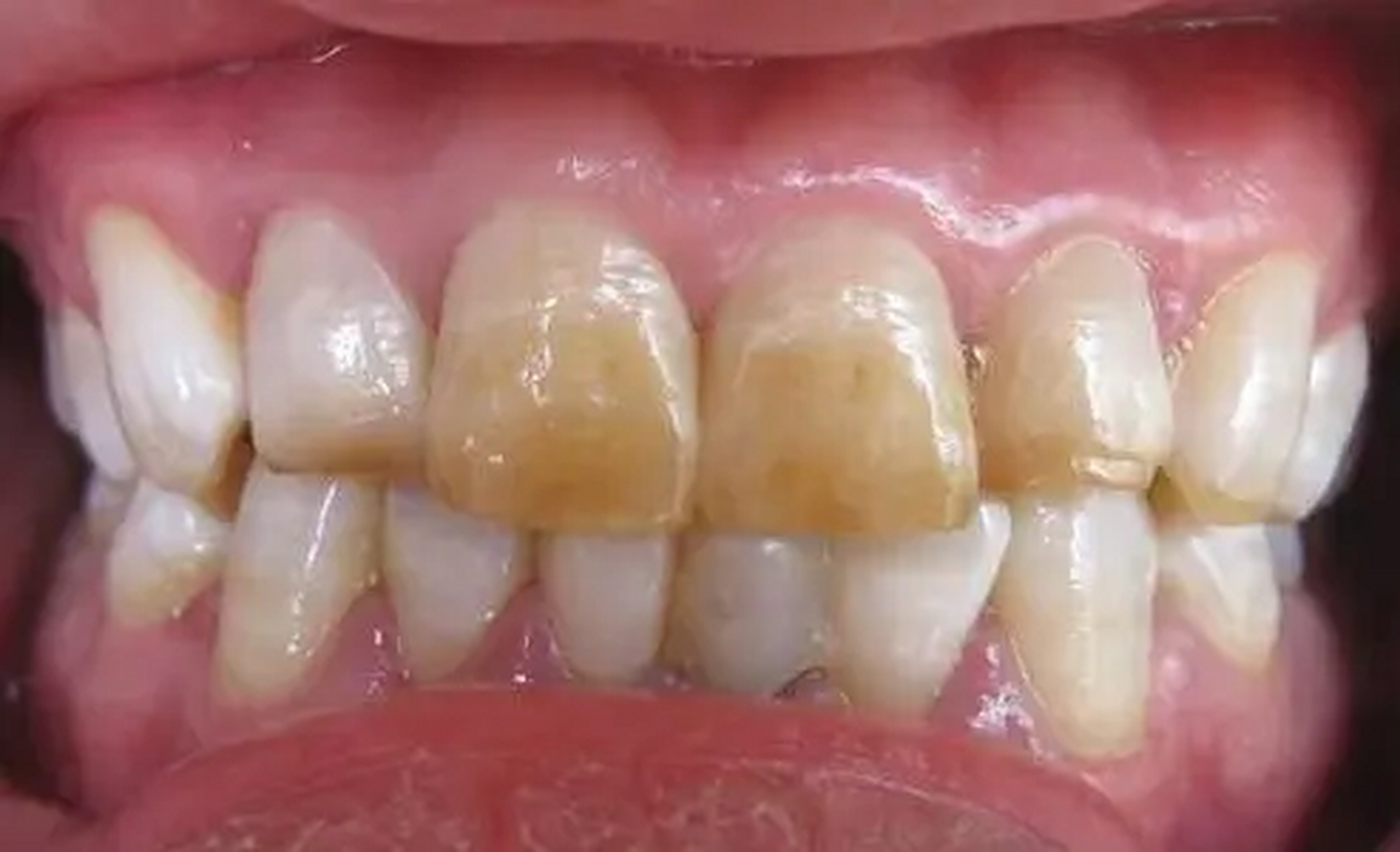 氟斑牙又称斑釉或黄斑牙,是一种与饮用水中氟含量过高有关的牙齿疾病