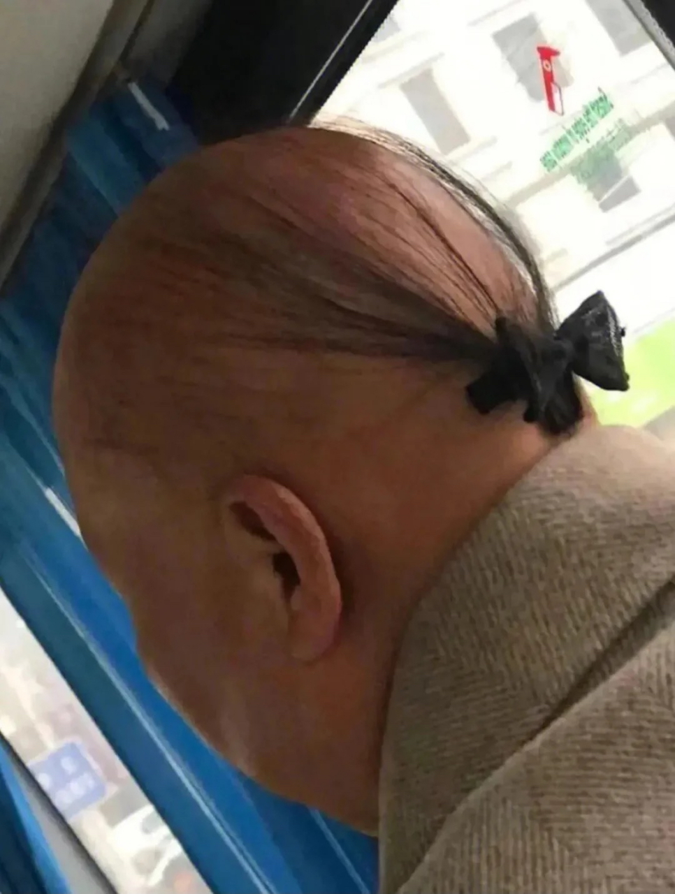 大娘这头发,让我感觉自己头顶也凉嗖嗖的,怎么治脱发啊?