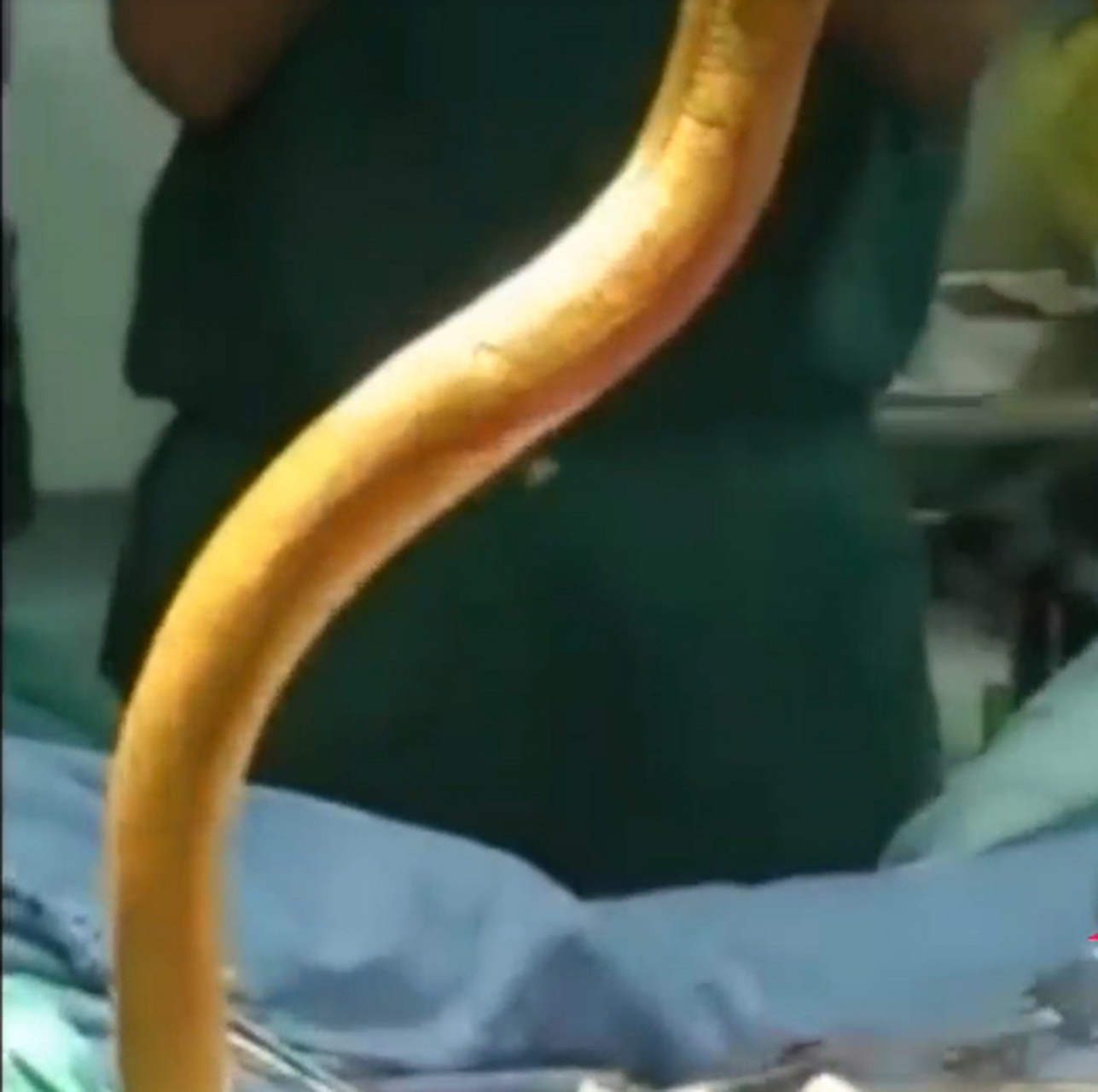 女主播不慎把黄鳝闷死在体内,最终到医院通过手术将黄鳝取出!