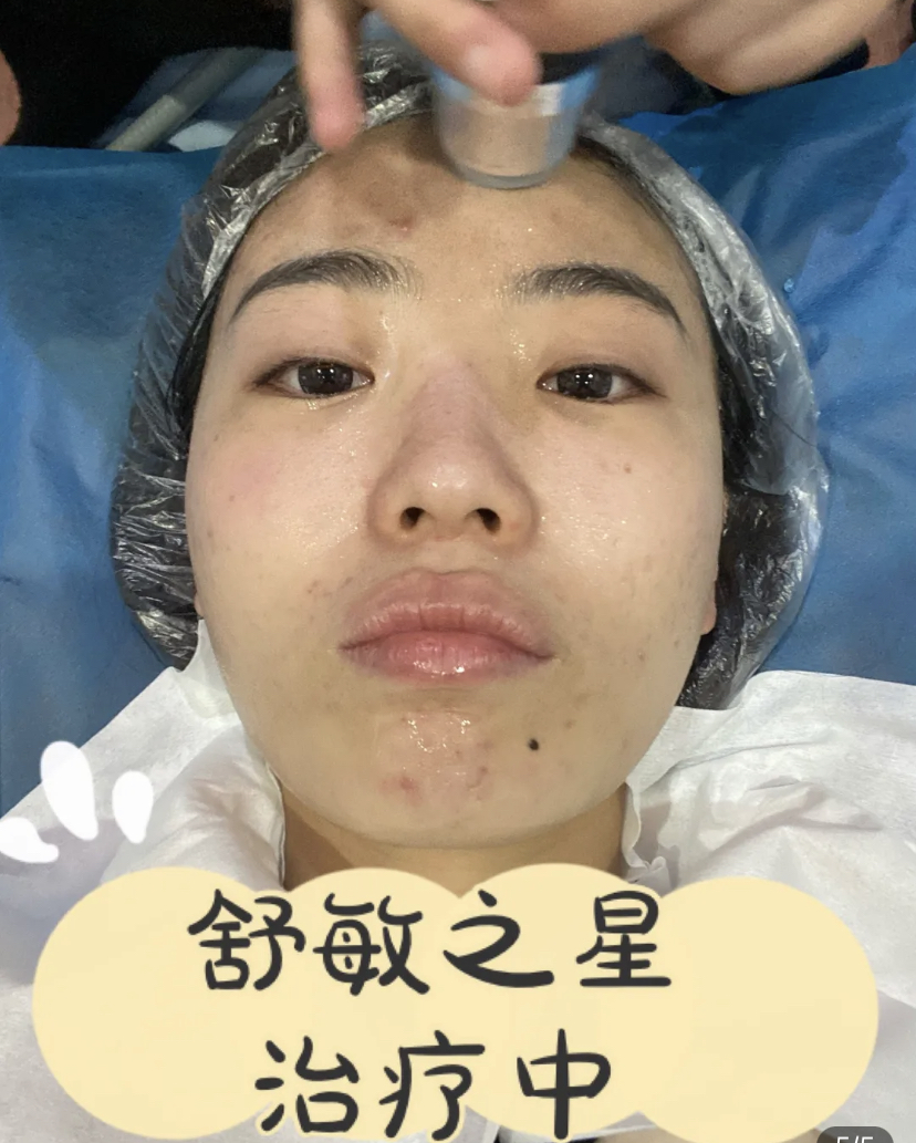 舒敏之星太牛了!皮肤敏感得到了缓解!