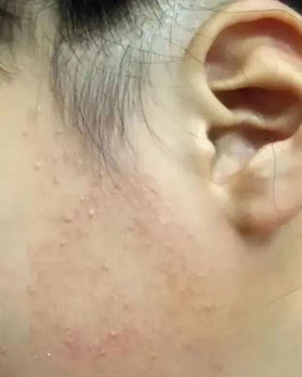 宝宝脸上长小疹子,红彤彤,摸着粗糙,还喜欢一个个的挤!