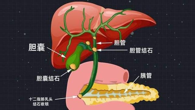 以前都是保胆取石