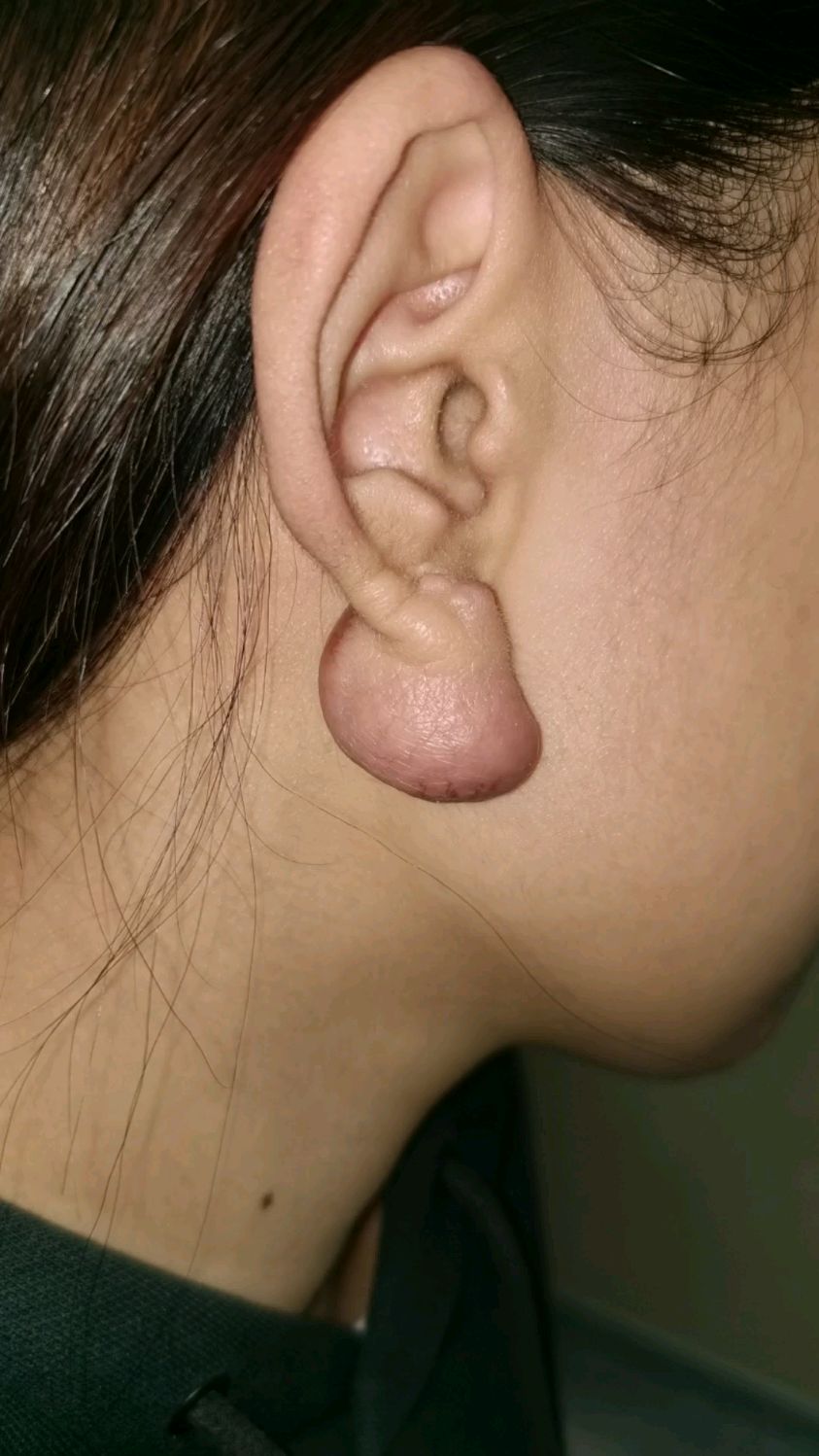 耳洞瘢痕疙瘩照片图片