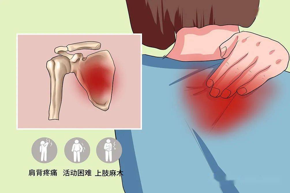 肩胛骨区域酸痛 肩胛骨 脊柱医生 健康科普