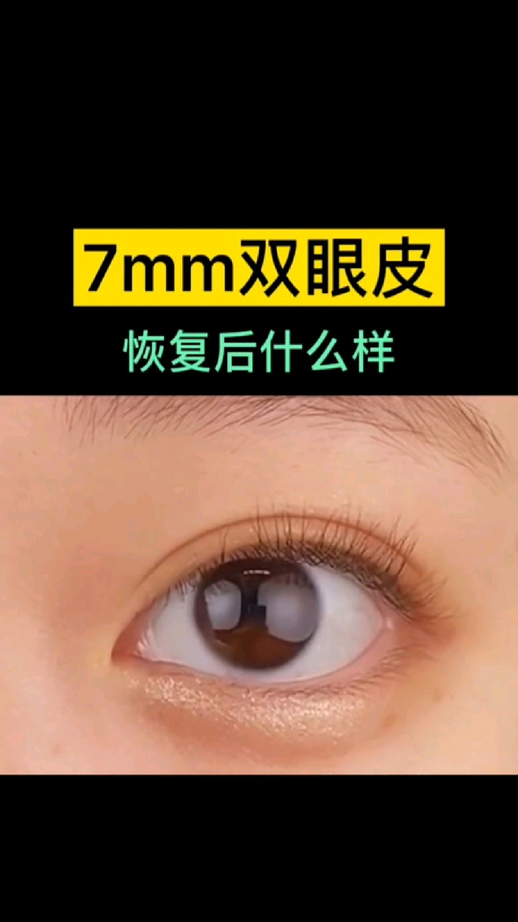 7mm双眼皮恢复后好看吗你的几mm