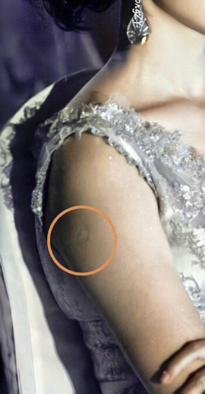 这是卡介苗留的疤吧?但是不知道为啥我没有留下那个疤.