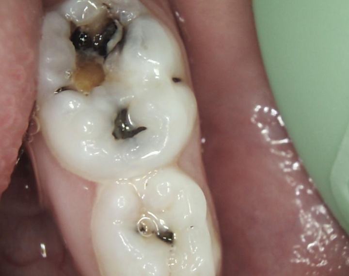 为什么会有龋齿,好好的牙齿怎么会有虫,蛀牙本质是什么