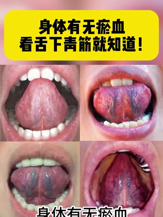 身体有无瘀血 看舌下青筋就知道!