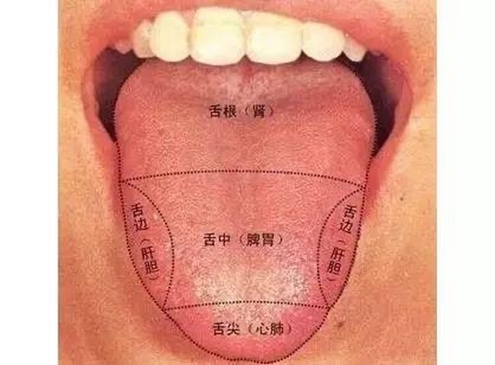 红绛舌有裂纹—知病症—热盛伤阴 2.