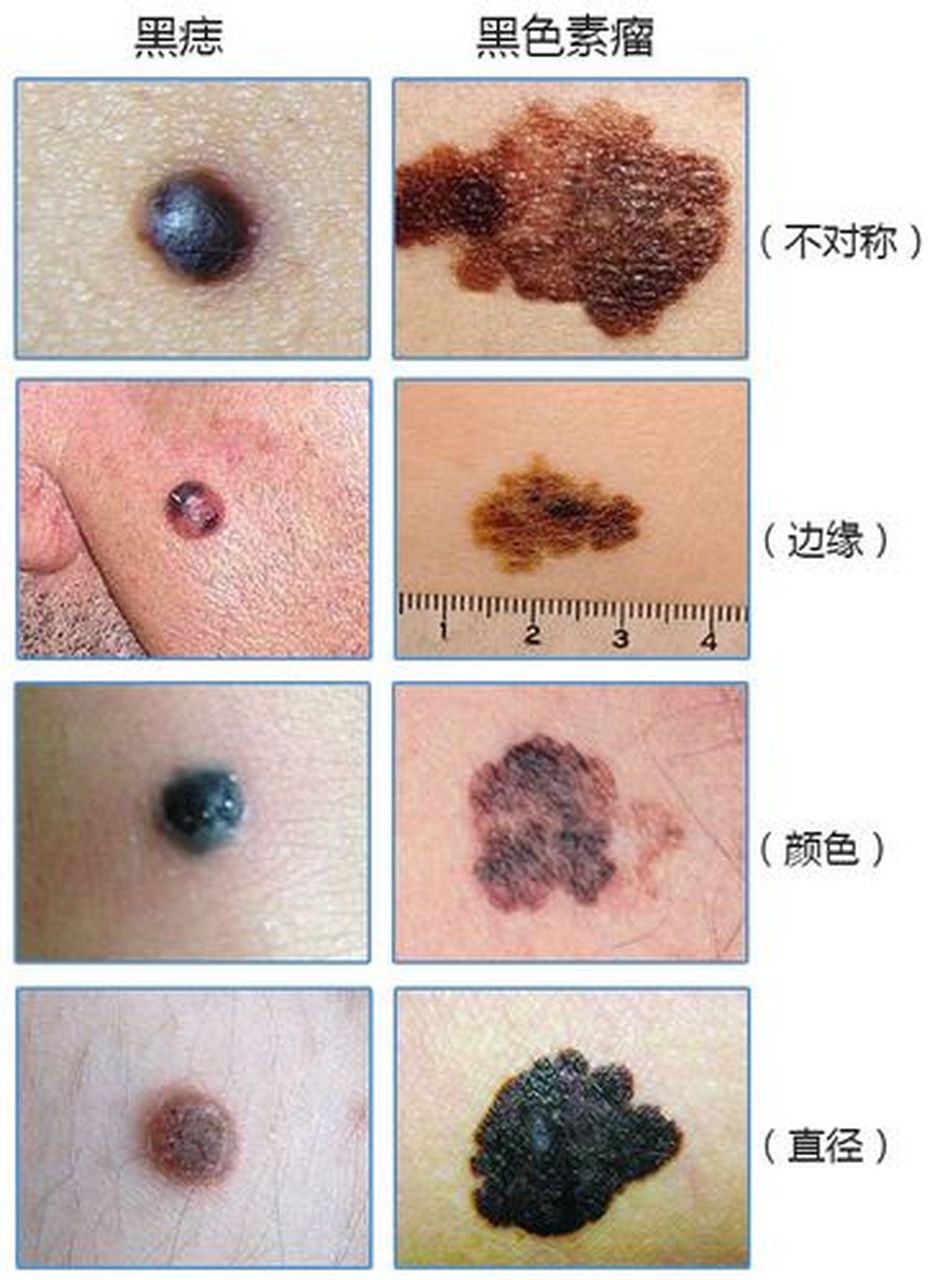 身上这种痣,到底要不要点?