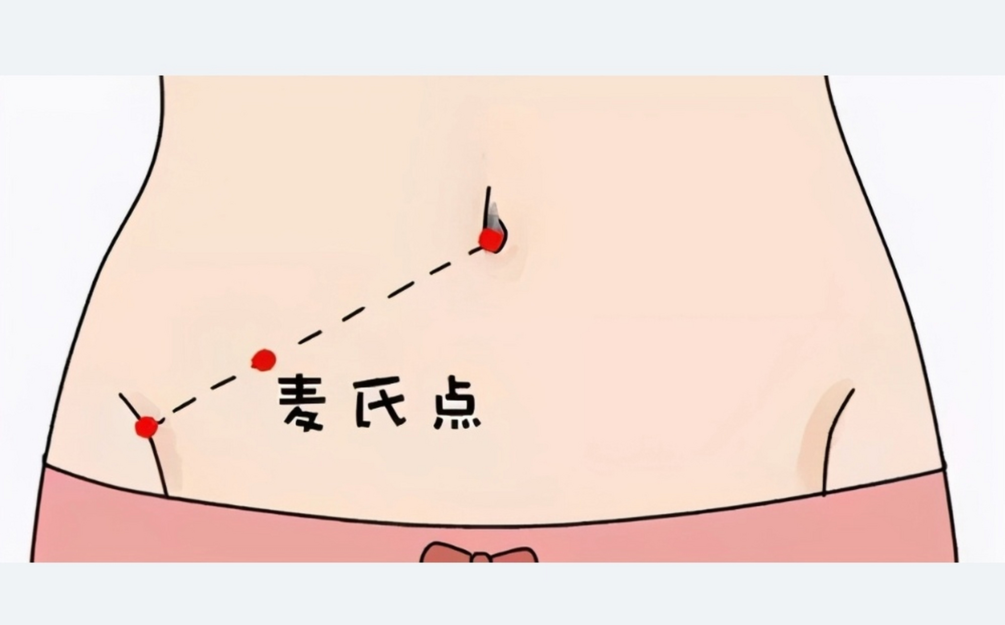 [二哈]  这是一个医学术语,这个位置在肚脐与右髂前上棘连线,中外三分