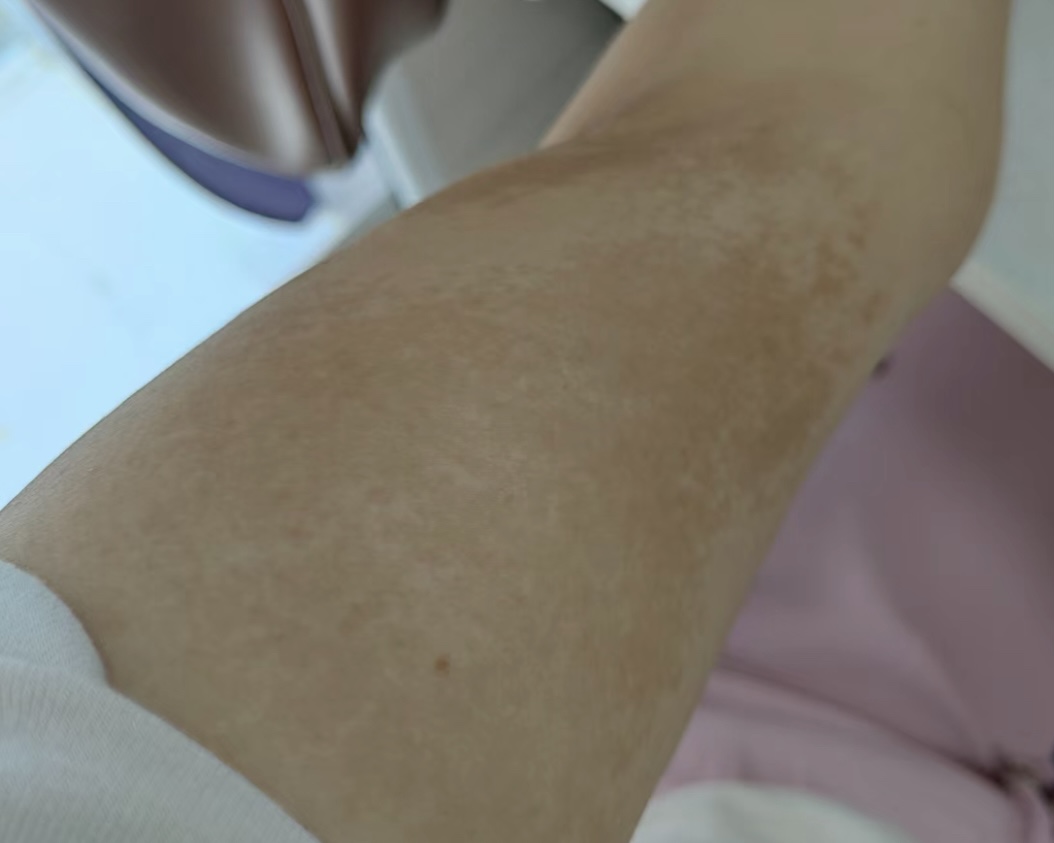 "咖啡斑"长了毛不要慌,看完这三点再下定论