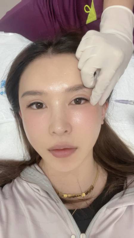 近距离看一下,眼周注射肉毒素-度小视