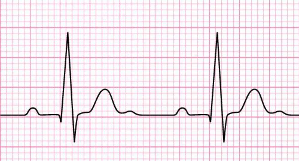 正常窦性心律图片