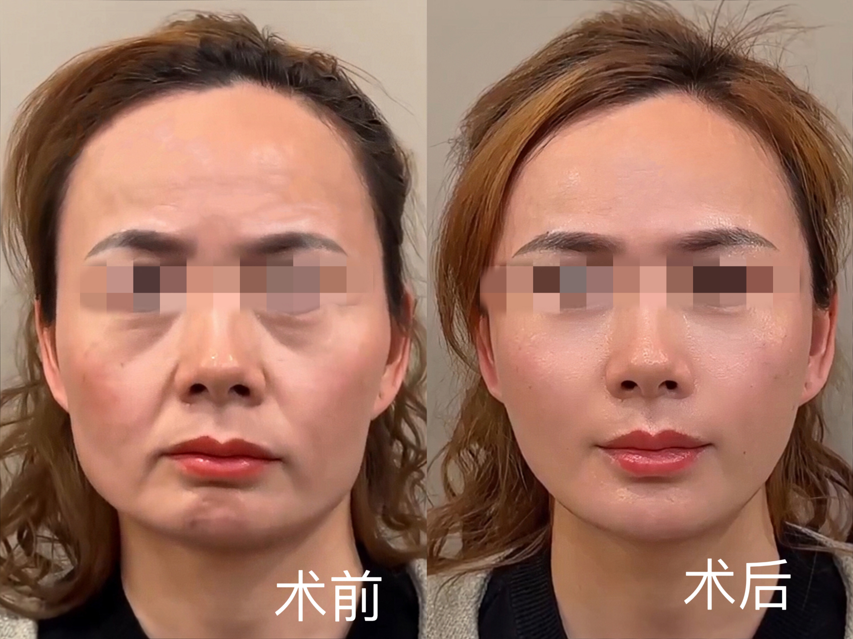 50岁大姐瞒着老公做了筋膜提升,年轻了20岁  之前做过线雕和填充效果