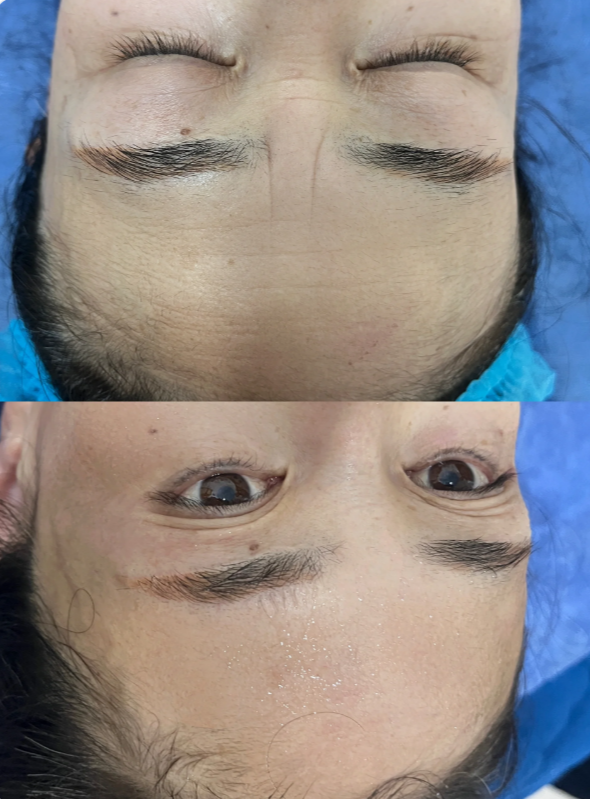 做完川字纹手术会复发吗?了解川字纹动态和静态两种类型