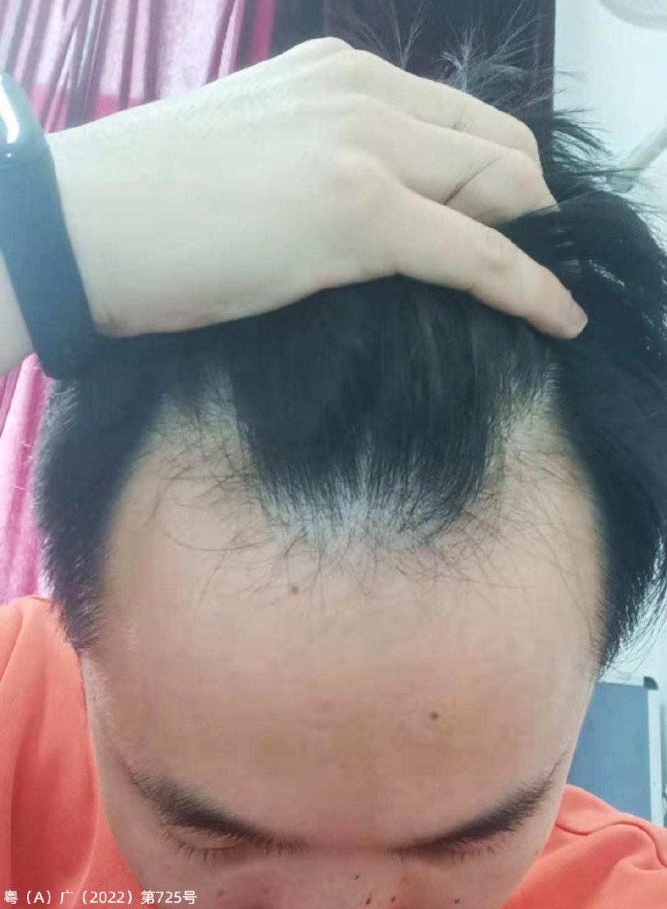 我是发际线上移,头发容易油.想问一下徐医生,我这个情况应该怎么办?