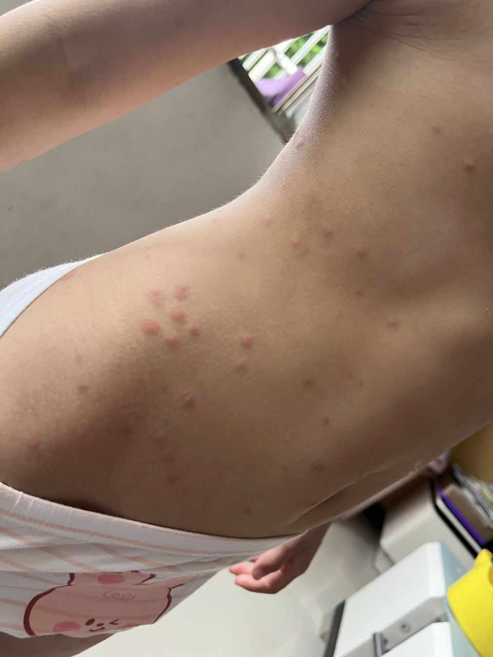 女儿身上的疮,很痒,看了好心疼,也去医院看了,医生说过敏,搞了吃的药