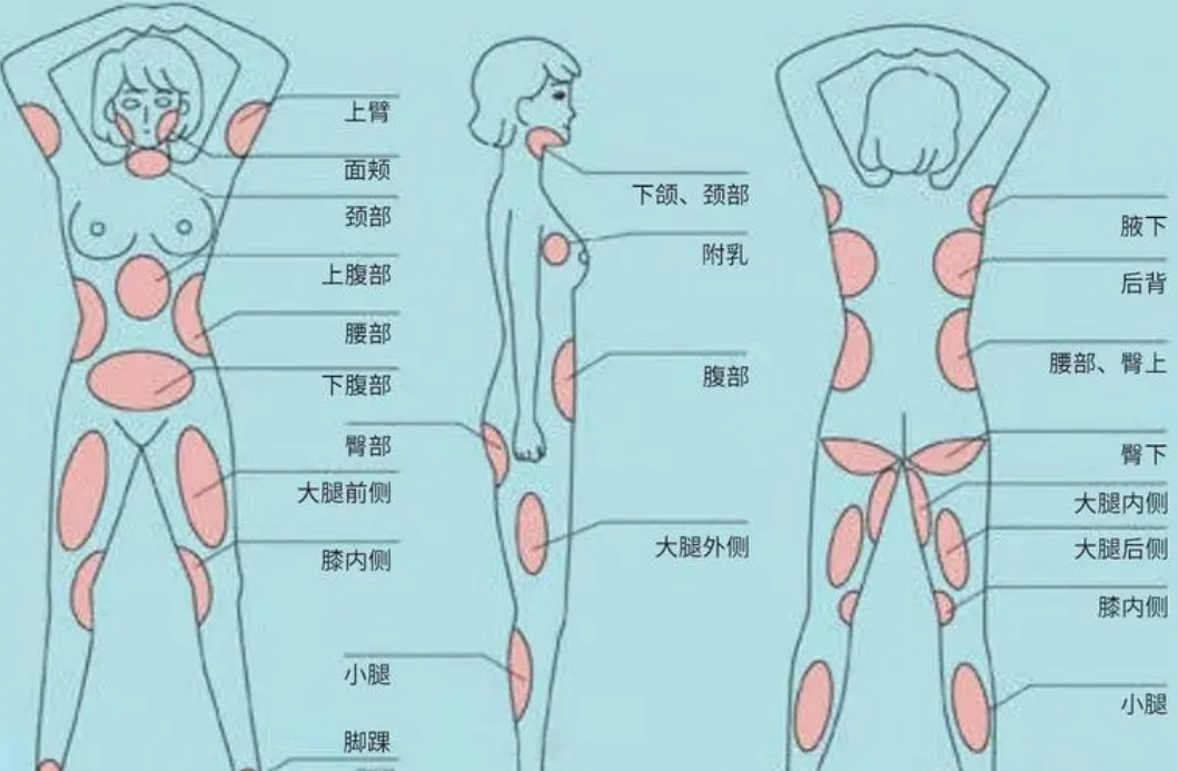 下图是人体脂肪易堆积的示意图,看看你的脂肪堆积在哪个部位?