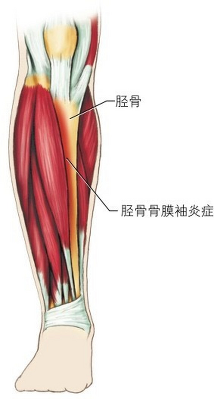 【小腿的胫骨骨膜炎 胫骨骨膜炎和内侧胫骨应力综合征(一种更严重的