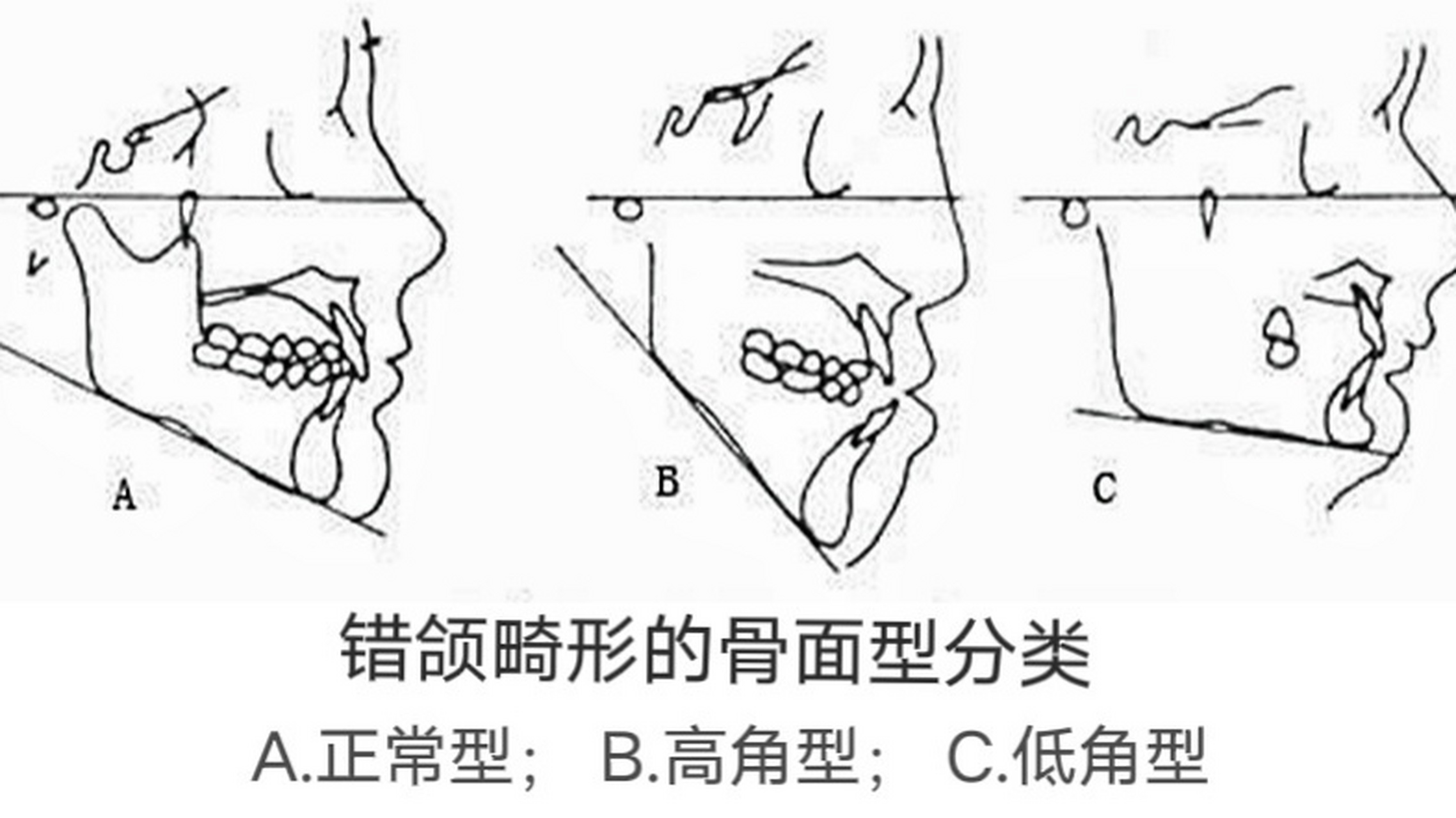 牙齿矫正# 为什么正畸低角病例,一般不建议拔牙矫正?