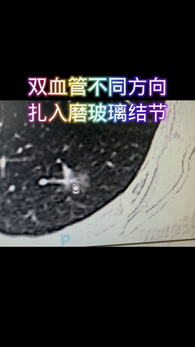 双血管不同方向 ,扎入磨玻璃结节